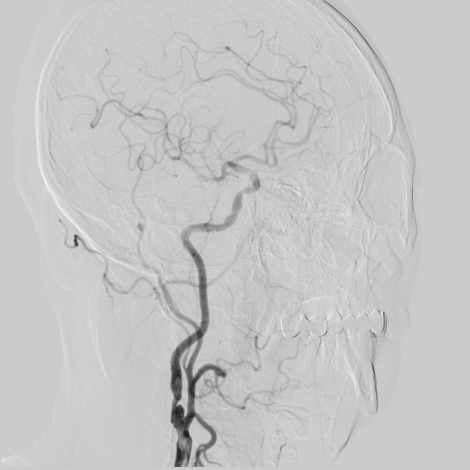 angiography system