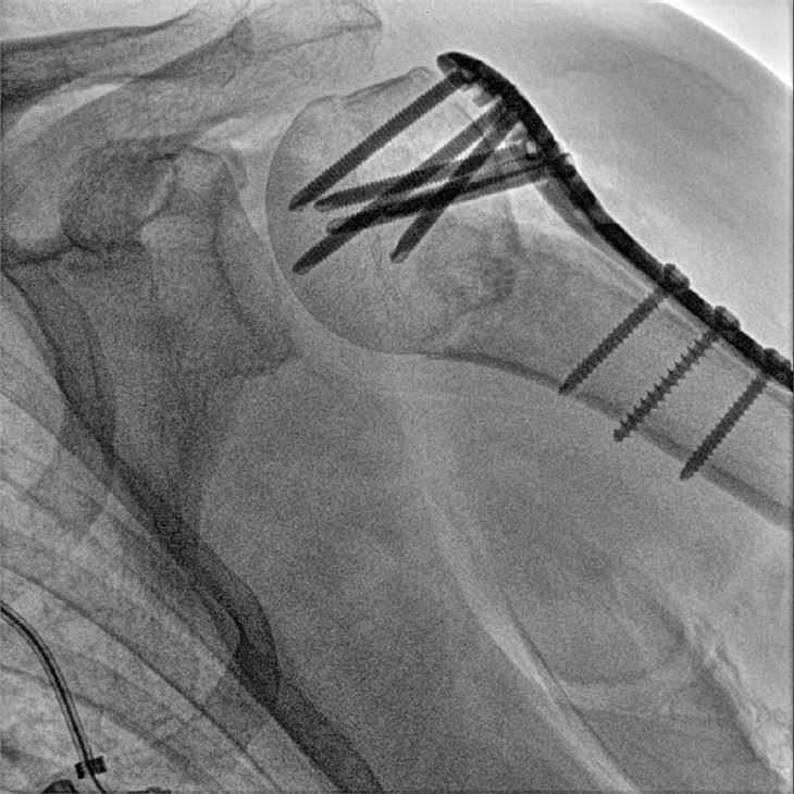 C Arm Fluoroscopy Machine